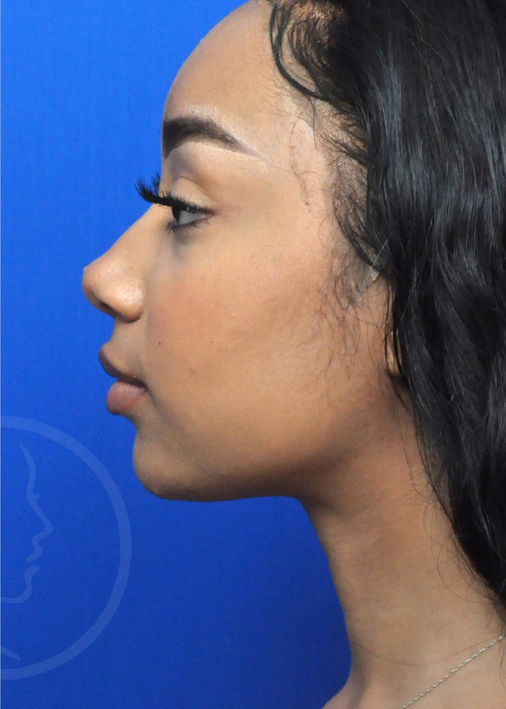 Neck Liposuction Before and After Pictures in Jacksonville, FL