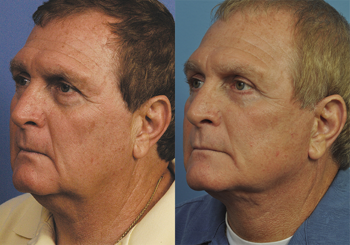 Male Neck Lift in Jacksonville, FL