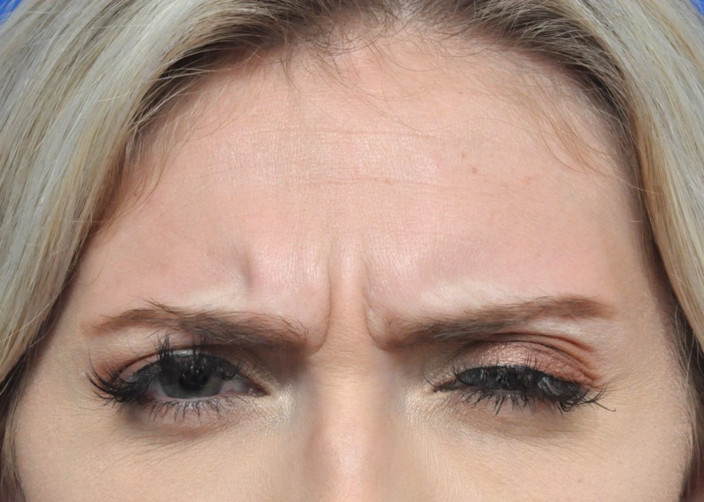 Plastic Surgery Before and After Pictures in Jacksonville, FL - Garcia Facial Plastic Surgery