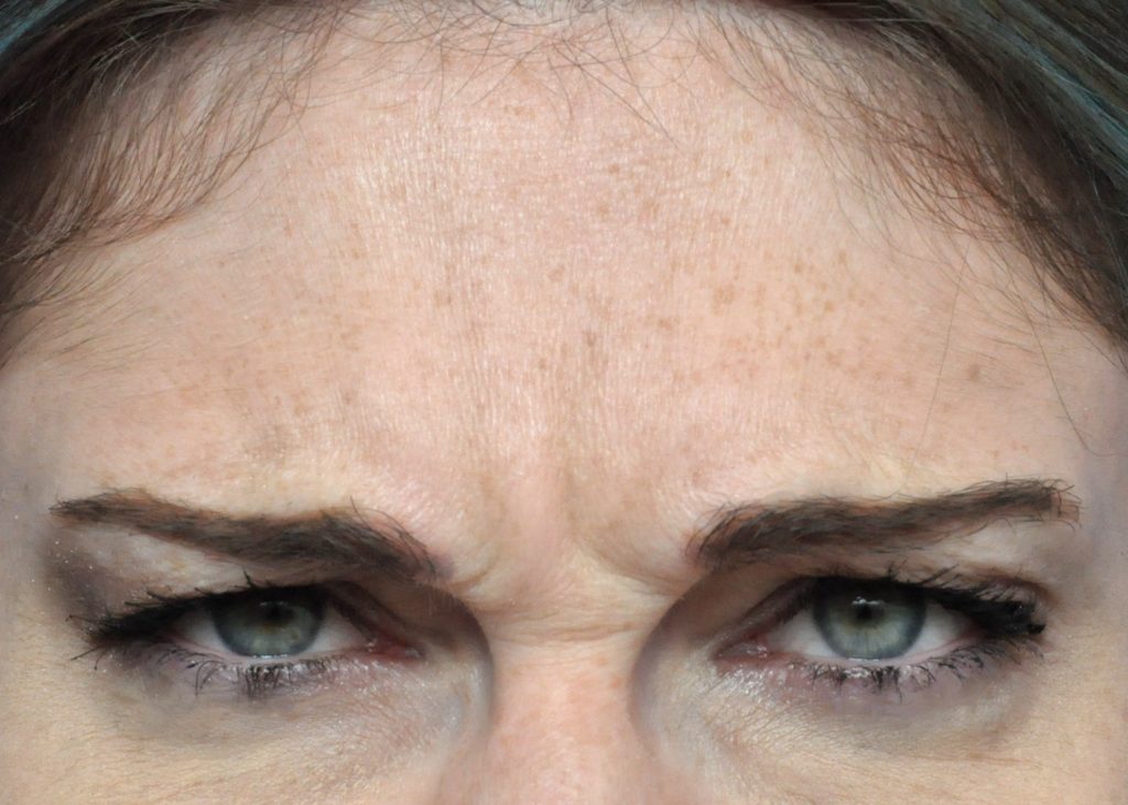 Plastic Surgery Before and After Pictures in Jacksonville, FL - Garcia Facial Plastic Surgery