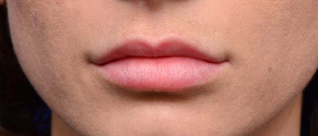 Plastic Surgery Before and After Pictures in Jacksonville, FL - Garcia Facial Plastic Surgery
