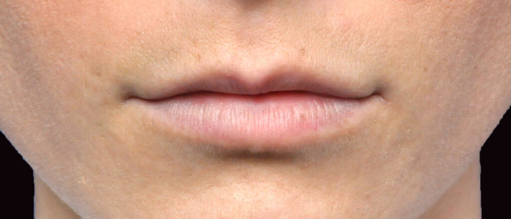 Plastic Surgery Before and After Pictures in Jacksonville, FL - Garcia Facial Plastic Surgery