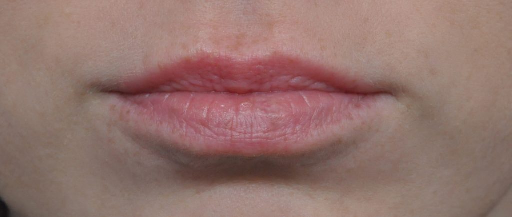 Juvederm® Before and After Pictures Jacksonville, FL