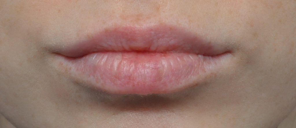 Juvederm® Before and After Pictures Jacksonville, FL