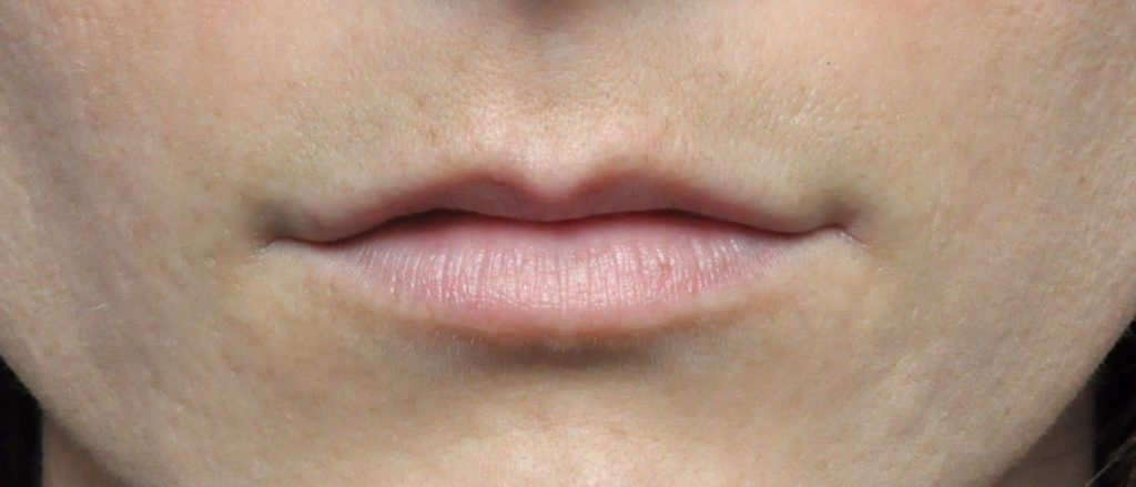 Juvederm® Before and After Pictures Jacksonville, FL