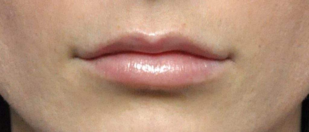 Juvederm® Before and After Pictures Jacksonville, FL