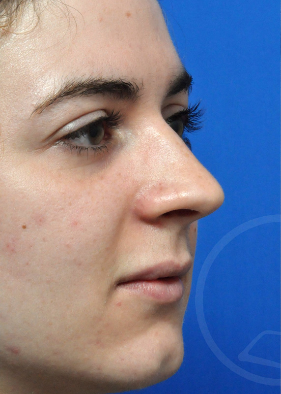 Rhinoplasty Before and After Pictures Jacksonville, FL