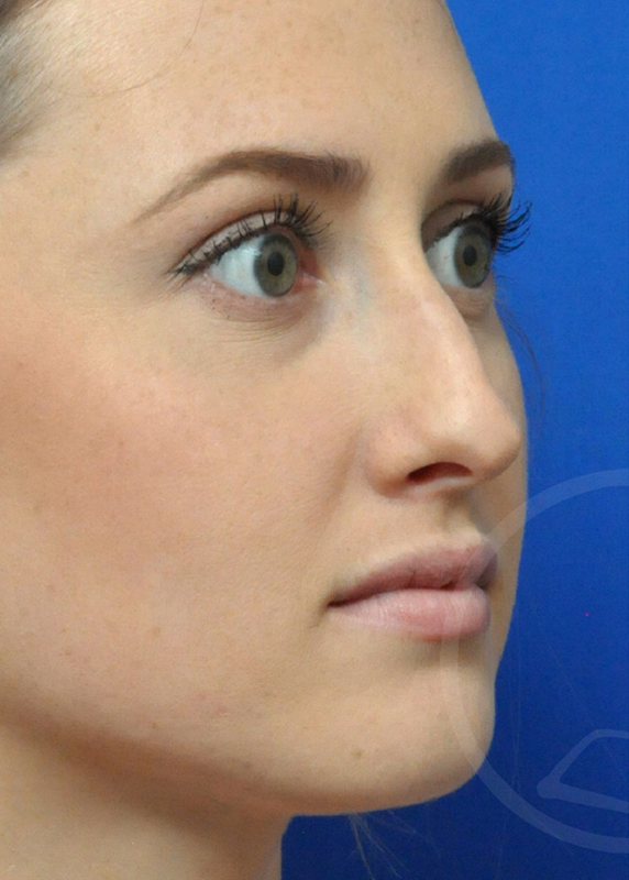 Rhinoplasty Before and After Pictures Jacksonville, FL