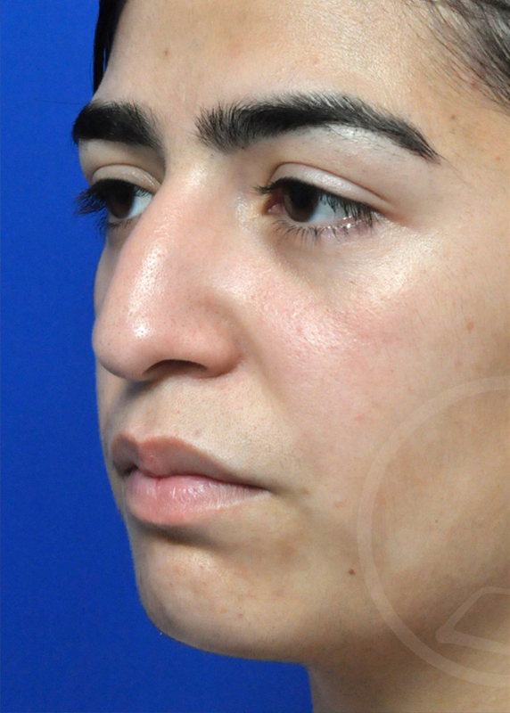 Rhinoplasty Before and After Pictures Jacksonville, FL