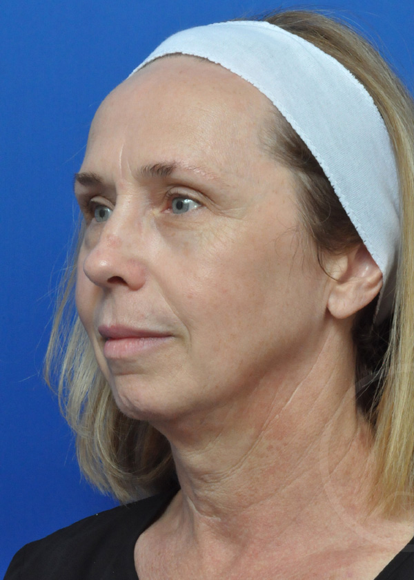 Facelift Before and After Pictures Jacksonville, FL