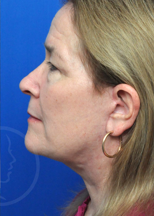 Facelift Before and After Pictures Jacksonville, FL