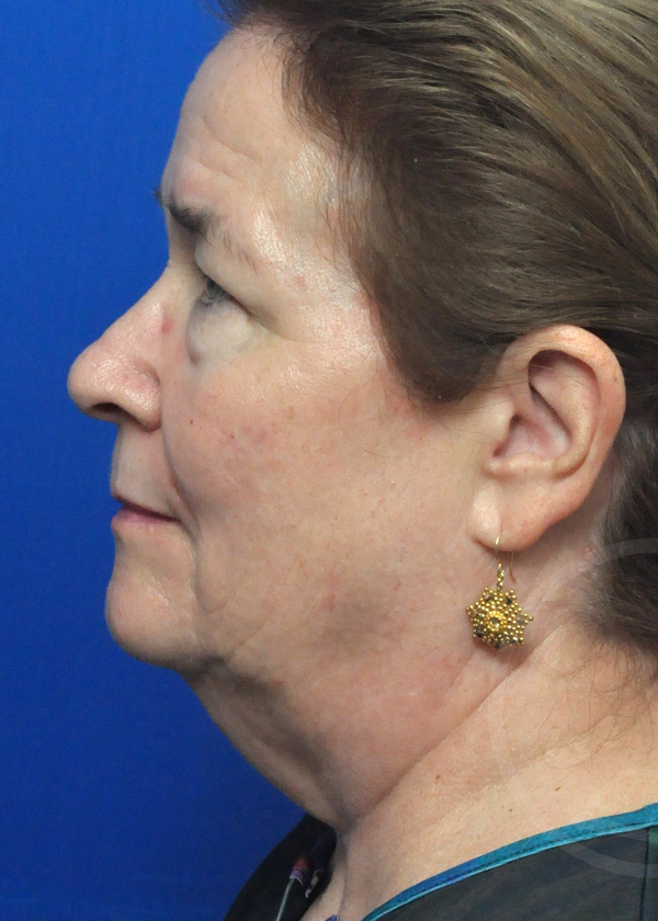 Facelift Before and After Pictures Jacksonville, FL