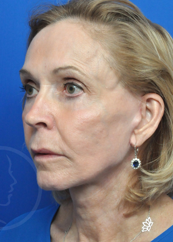 Facelift Before and After Pictures Jacksonville, FL