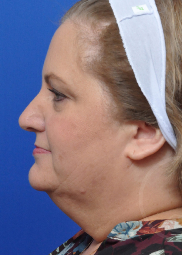 Facelift Before and After Pictures Jacksonville, FL