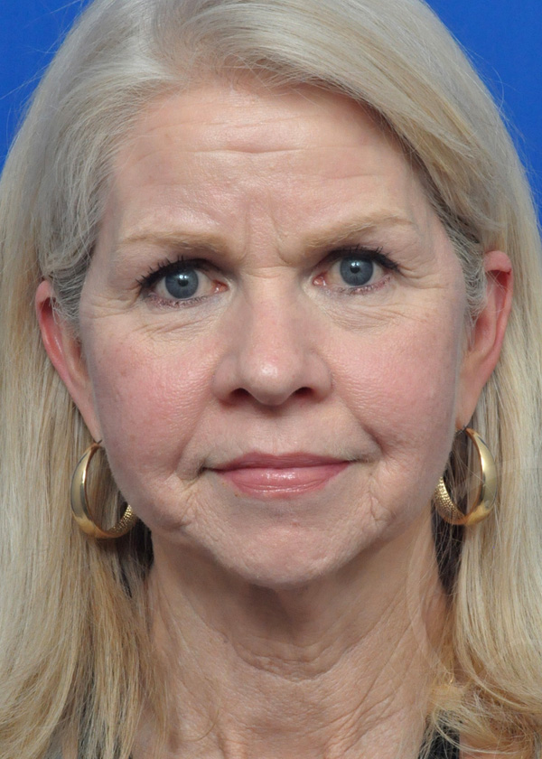 Facelift Before and After Pictures Jacksonville, FL