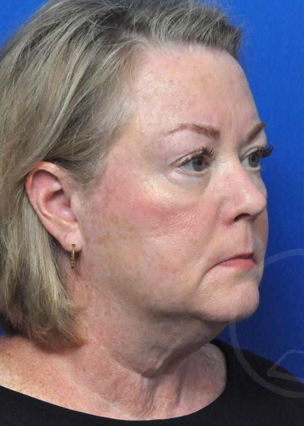 Facelift Before and After Pictures Jacksonville, FL