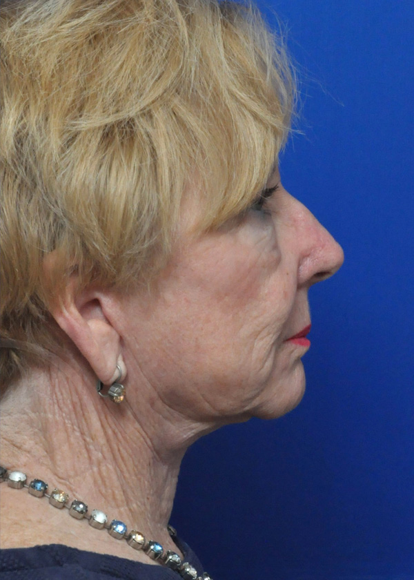 Facelift Before and After Pictures Jacksonville, FL