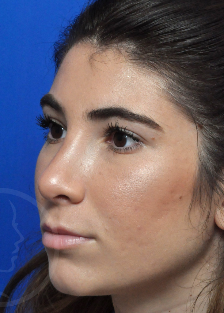 Rhinoplasty Before and After Pictures Jacksonville, FL