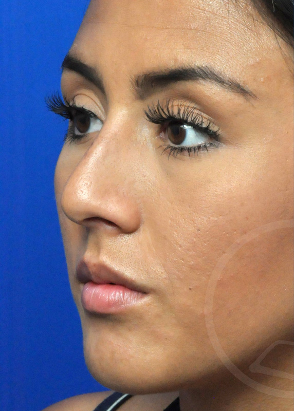 Rhinoplasty Before and After Pictures Jacksonville, FL