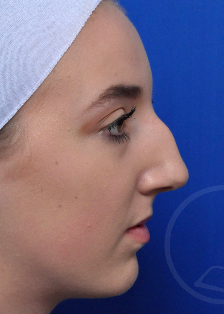 Rhinoplasty Before and After Pictures Jacksonville, FL