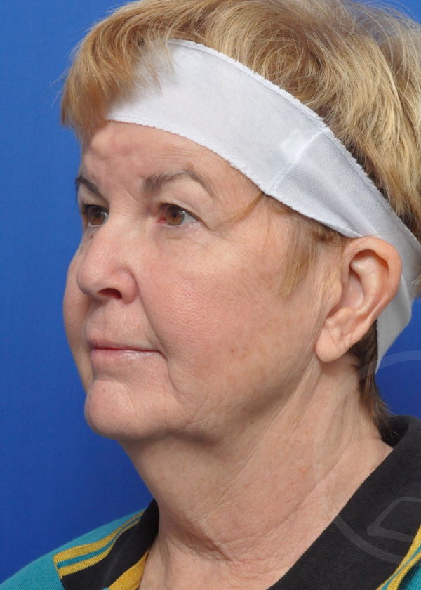 Facelift Before and After Pictures Jacksonville, FL