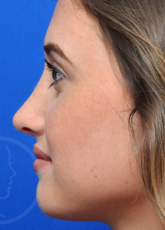 Rhinoplasty Before and After Pictures Jacksonville, FL