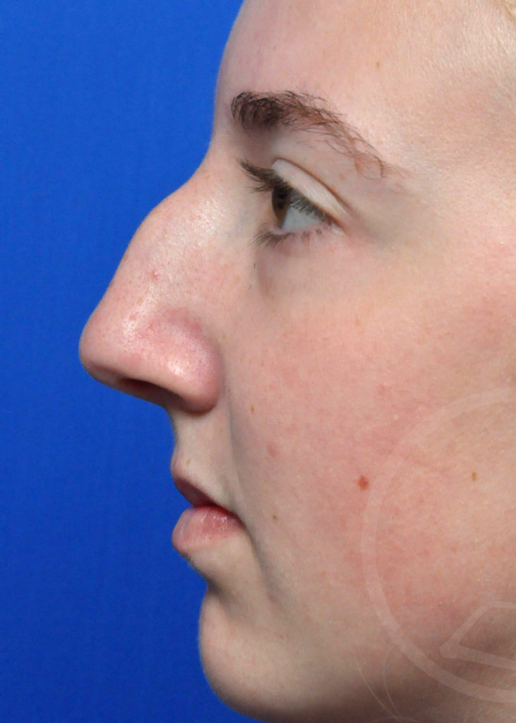 Rhinoplasty Before and After Pictures Jacksonville, FL