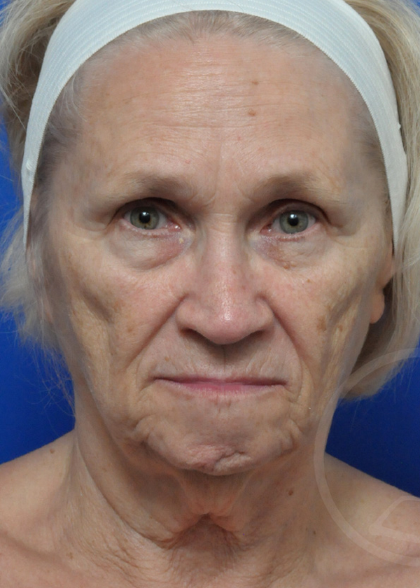 Facelift Before and After Pictures Jacksonville, FL