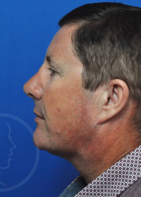 Rhinoplasty Before and After Pictures Jacksonville, FL