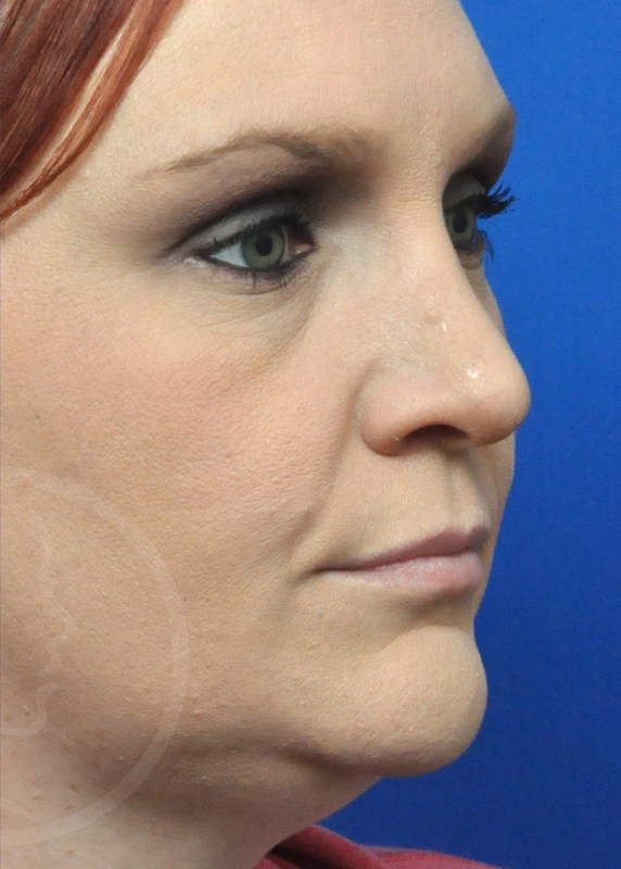 Rhinoplasty Before and After Pictures Jacksonville, FL