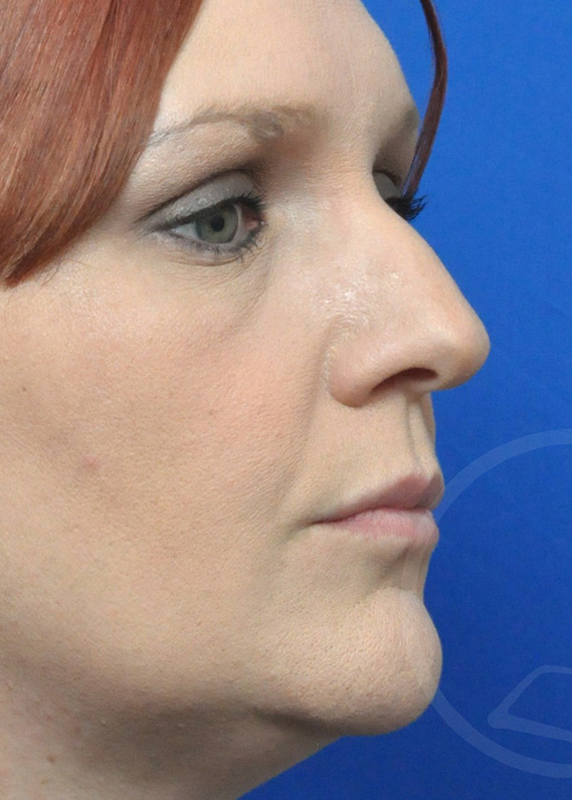 Rhinoplasty Before and After Pictures Jacksonville, FL