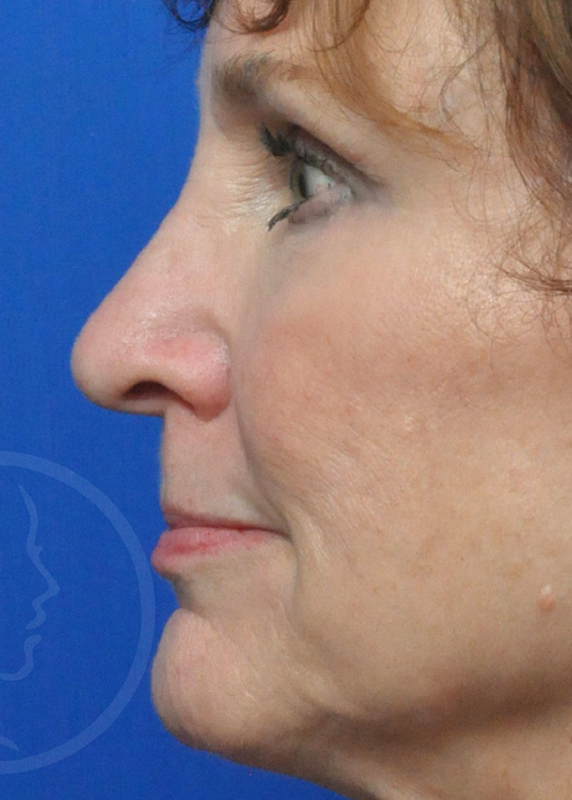 Rhinoplasty Before and After Pictures Jacksonville, FL