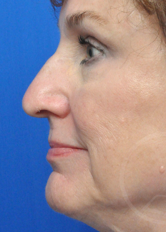 Rhinoplasty Before and After Pictures Jacksonville, FL