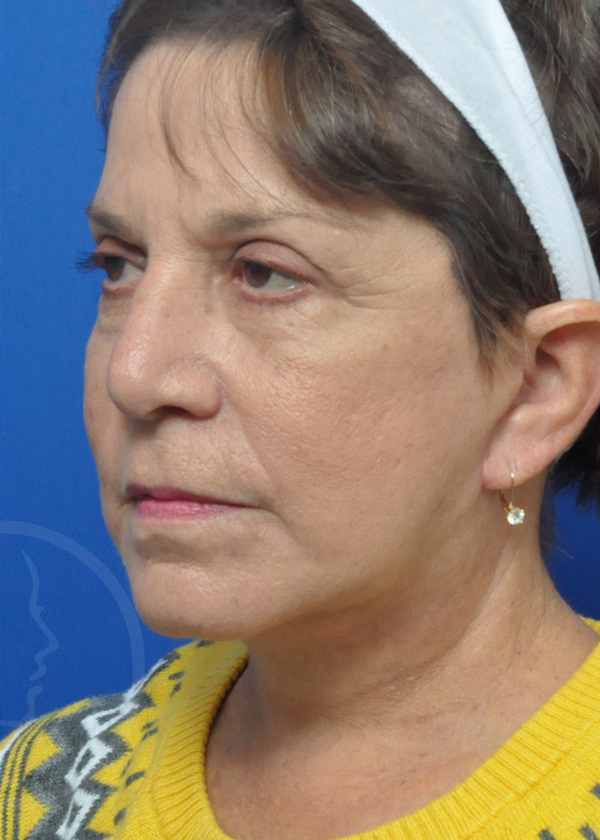 Facelift Before and After Pictures Jacksonville, FL