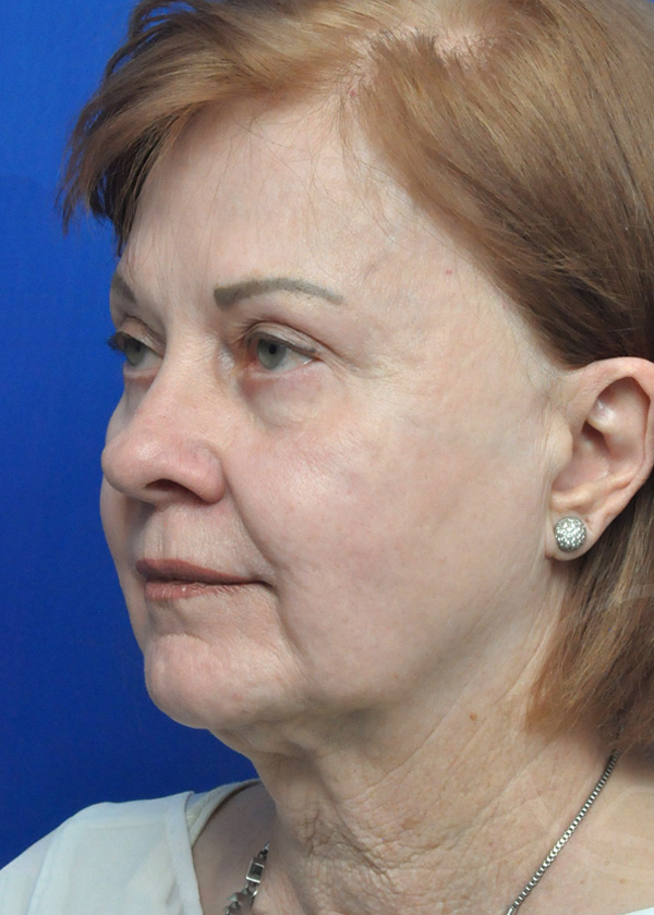 Facelift Before and After Pictures Jacksonville, FL