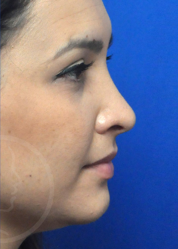 Rhinoplasty Before and After Pictures Jacksonville, FL