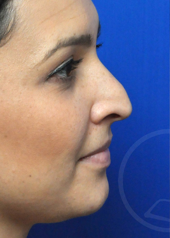 Rhinoplasty Before and After Pictures Jacksonville, FL