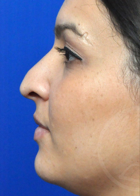 Rhinoplasty Before and After Pictures Jacksonville, FL