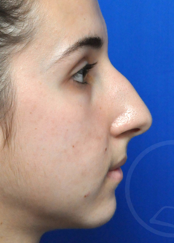 Rhinoplasty Before and After Pictures Jacksonville, FL