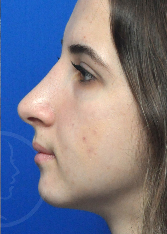 Rhinoplasty Before and After Pictures Jacksonville, FL