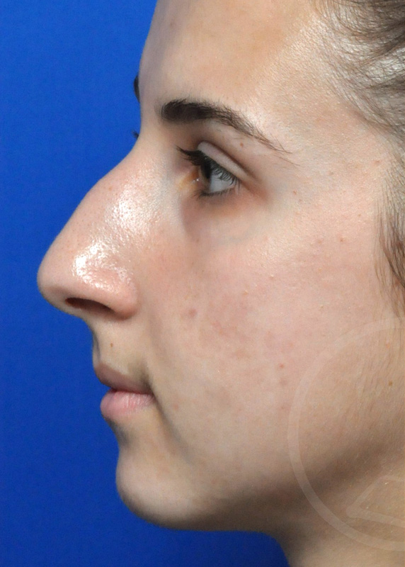 Rhinoplasty Before and After Pictures Jacksonville, FL