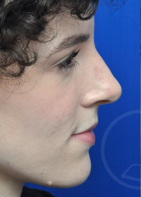 Rhinoplasty Before and After Pictures Jacksonville, FL