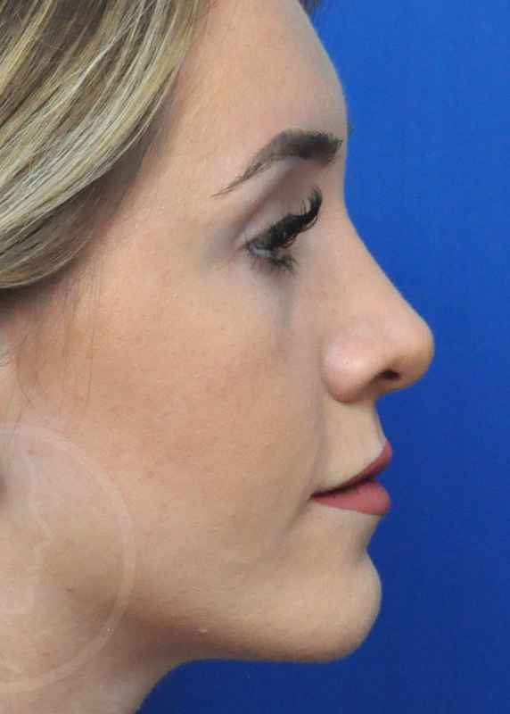 Rhinoplasty Before and After Pictures Jacksonville, FL