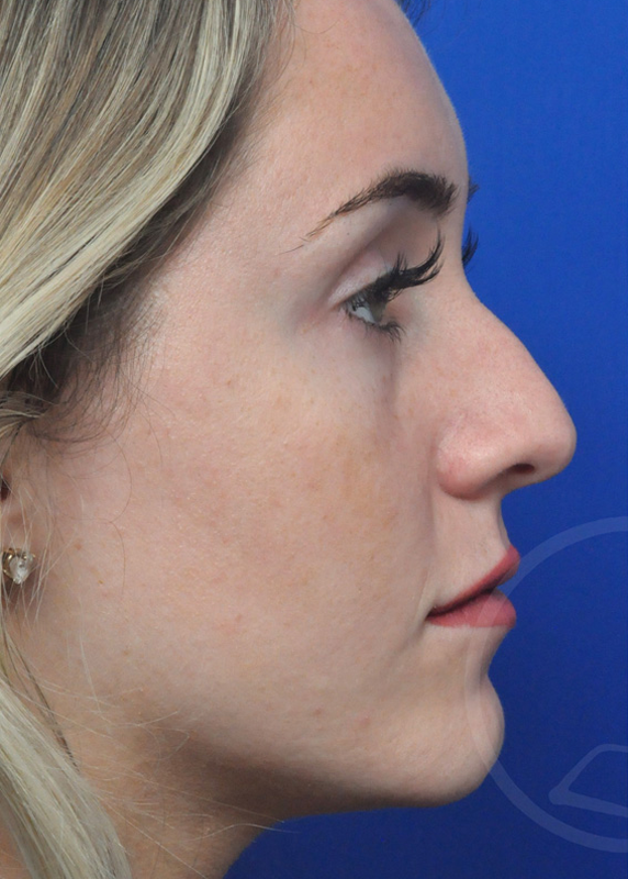 Rhinoplasty Before and After Pictures Jacksonville, FL