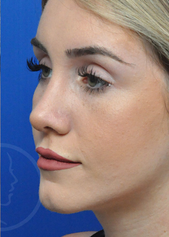 Rhinoplasty Before and After Pictures Jacksonville, FL