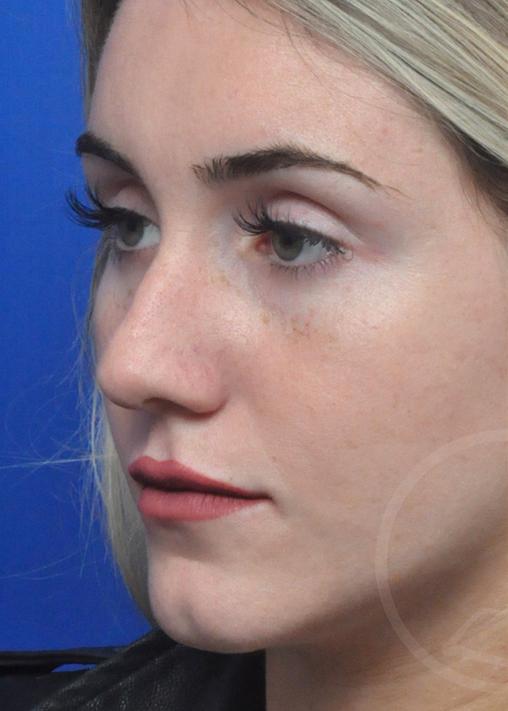 Rhinoplasty Before and After Pictures Jacksonville, FL