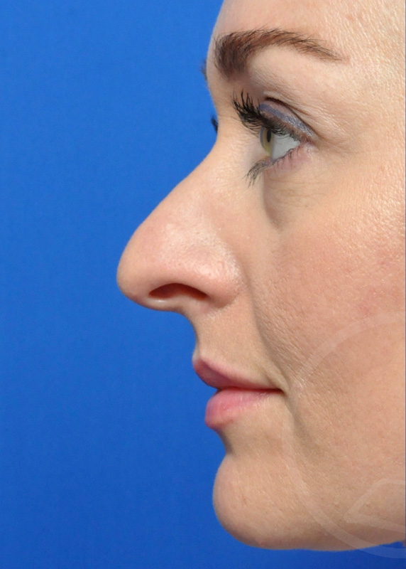 Rhinoplasty Before and After Pictures Jacksonville, FL