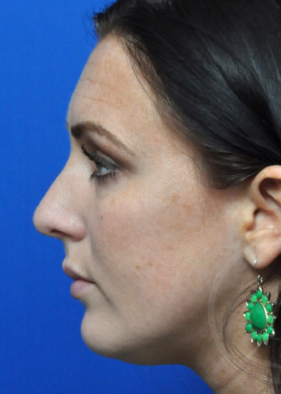 Rhinoplasty Before and After Pictures Jacksonville, FL