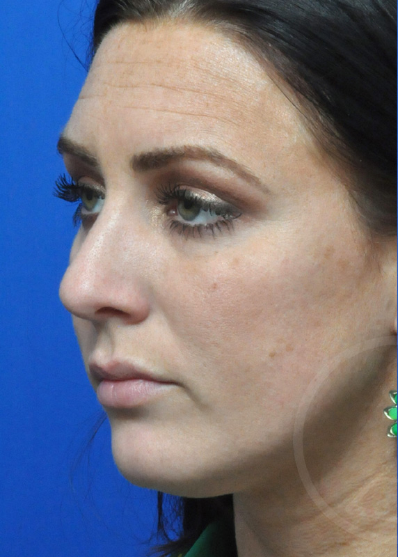 Rhinoplasty Before and After Pictures Jacksonville, FL