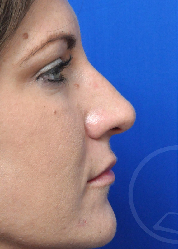 Rhinoplasty Before and After Pictures Jacksonville, FL